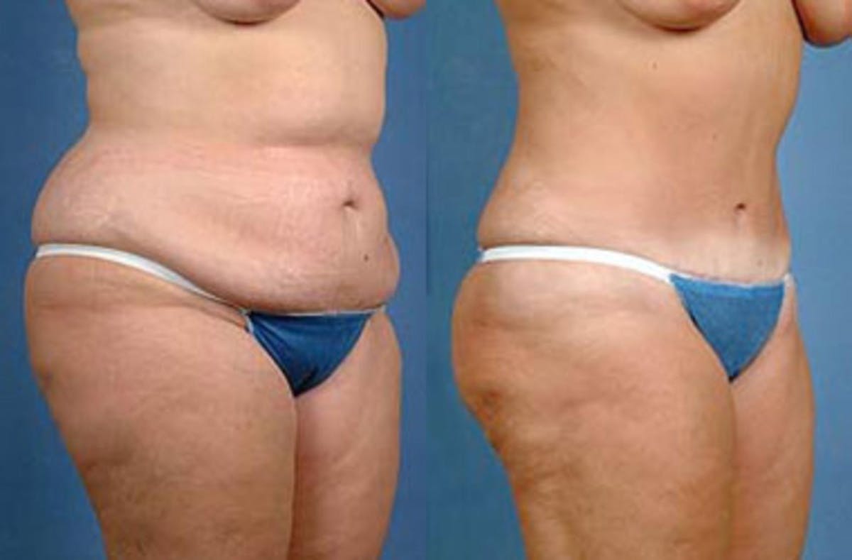 Tummy Tuck Before & After Gallery - Patient 246942 - Image 2