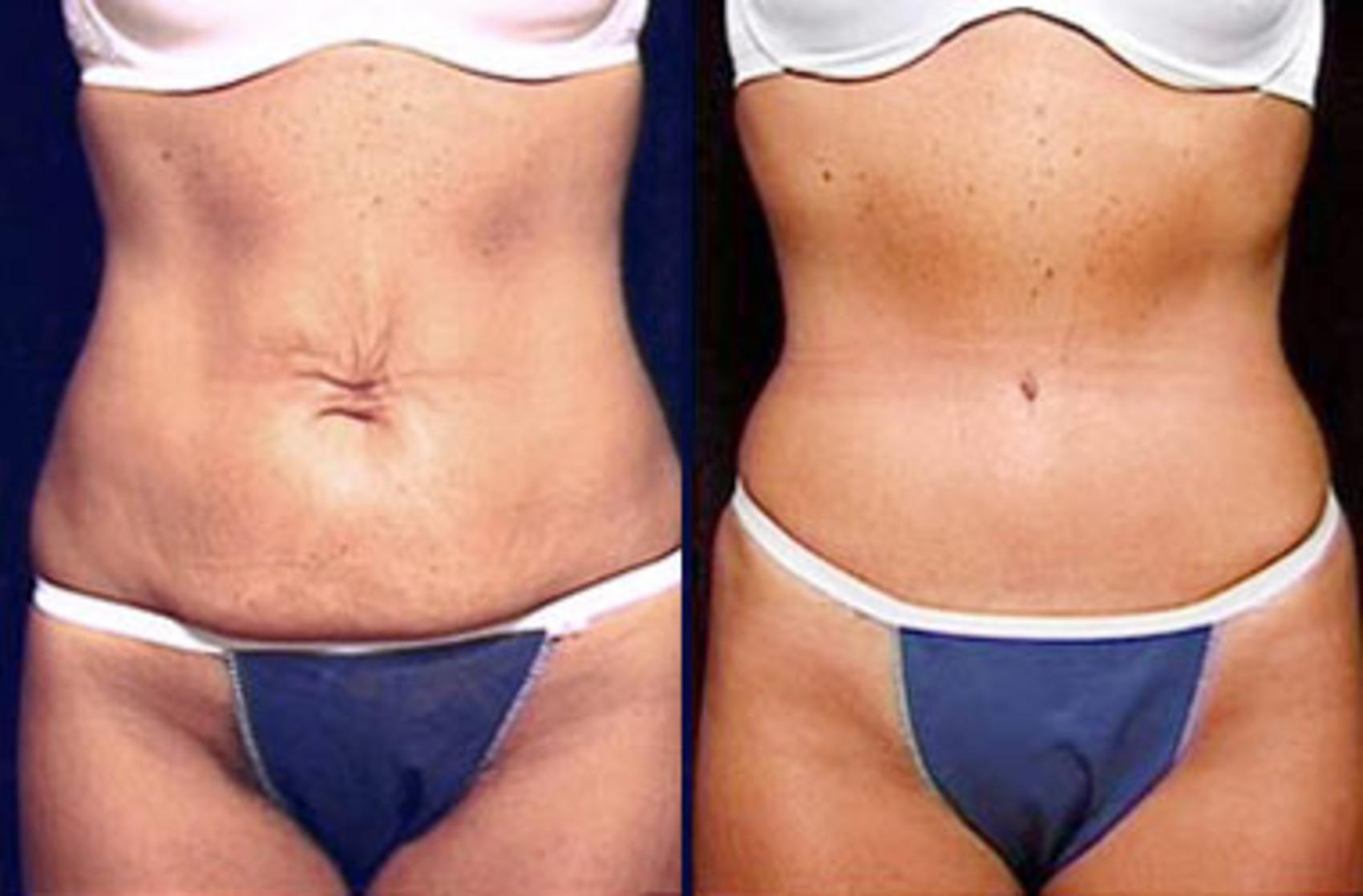 tummy tuck results