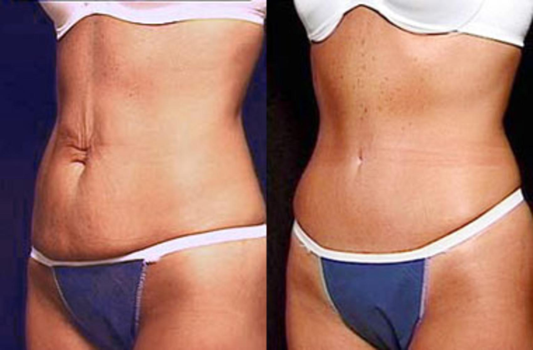 tummy tuck surgery results