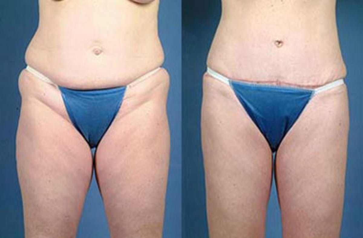 Tummy Tuck Before & After Gallery - Patient 279200 - Image 1
