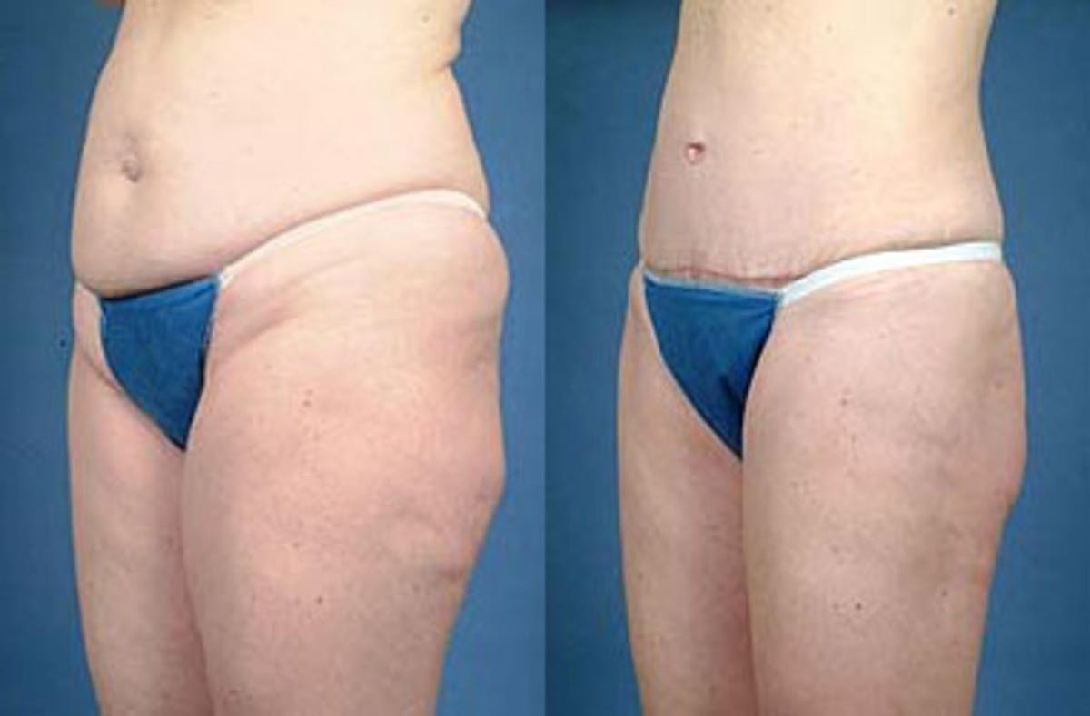 Tummy Tuck Before & After Gallery - Patient 279200 - Image 2