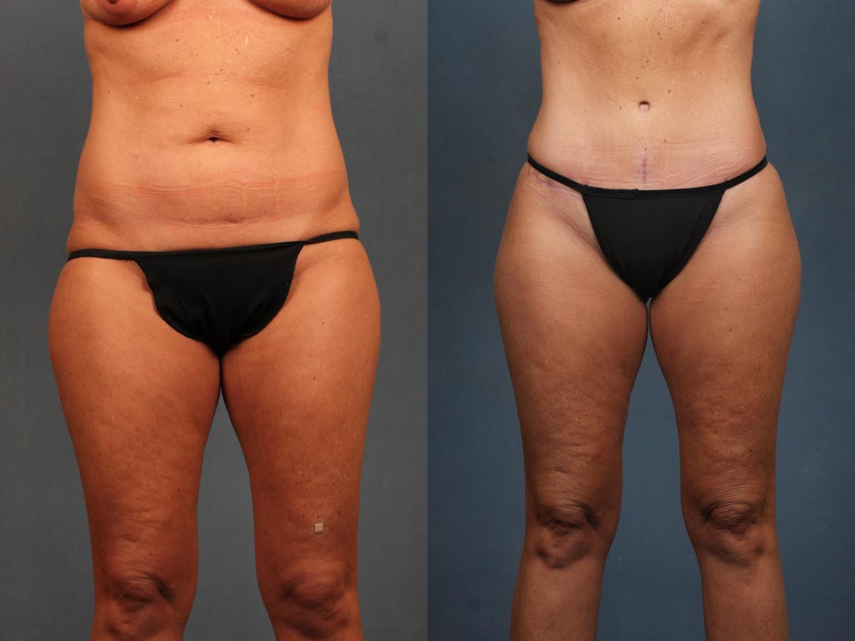 Tummy Tuck Before & After Gallery - Patient 347666 - Image 1