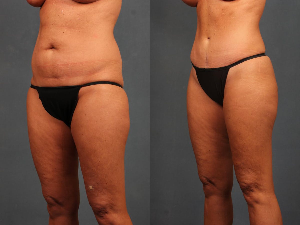 Tummy Tuck Before & After Gallery - Patient 347666 - Image 2