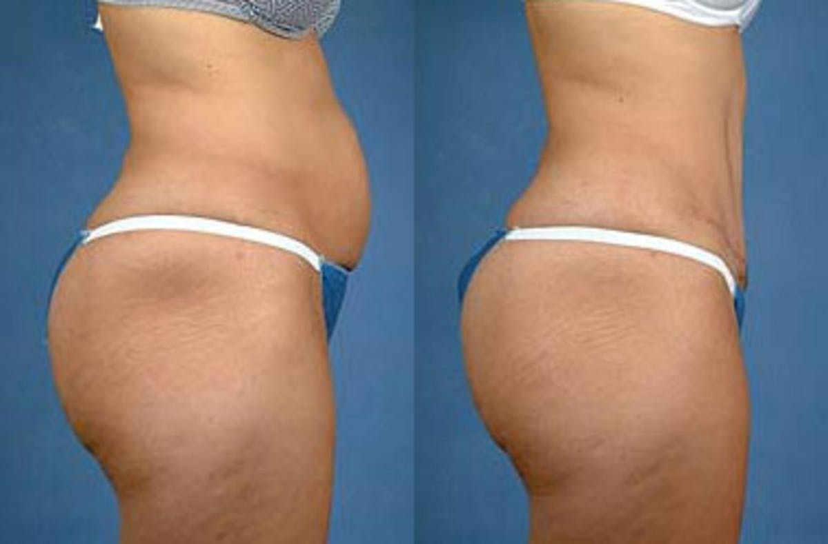 Tummy Tuck Before & After Gallery - Patient 303955 - Image 2