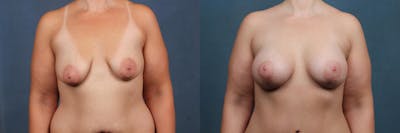 Mommy Makeover Before & After Gallery - Patient 390571 - Image 1
