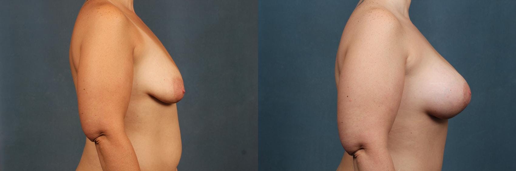 Lift Before & After Gallery - Patient 203546 - Image 3
