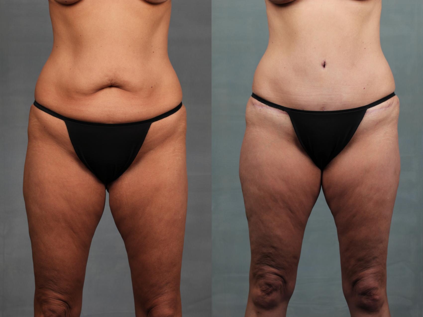 mommy makeover results