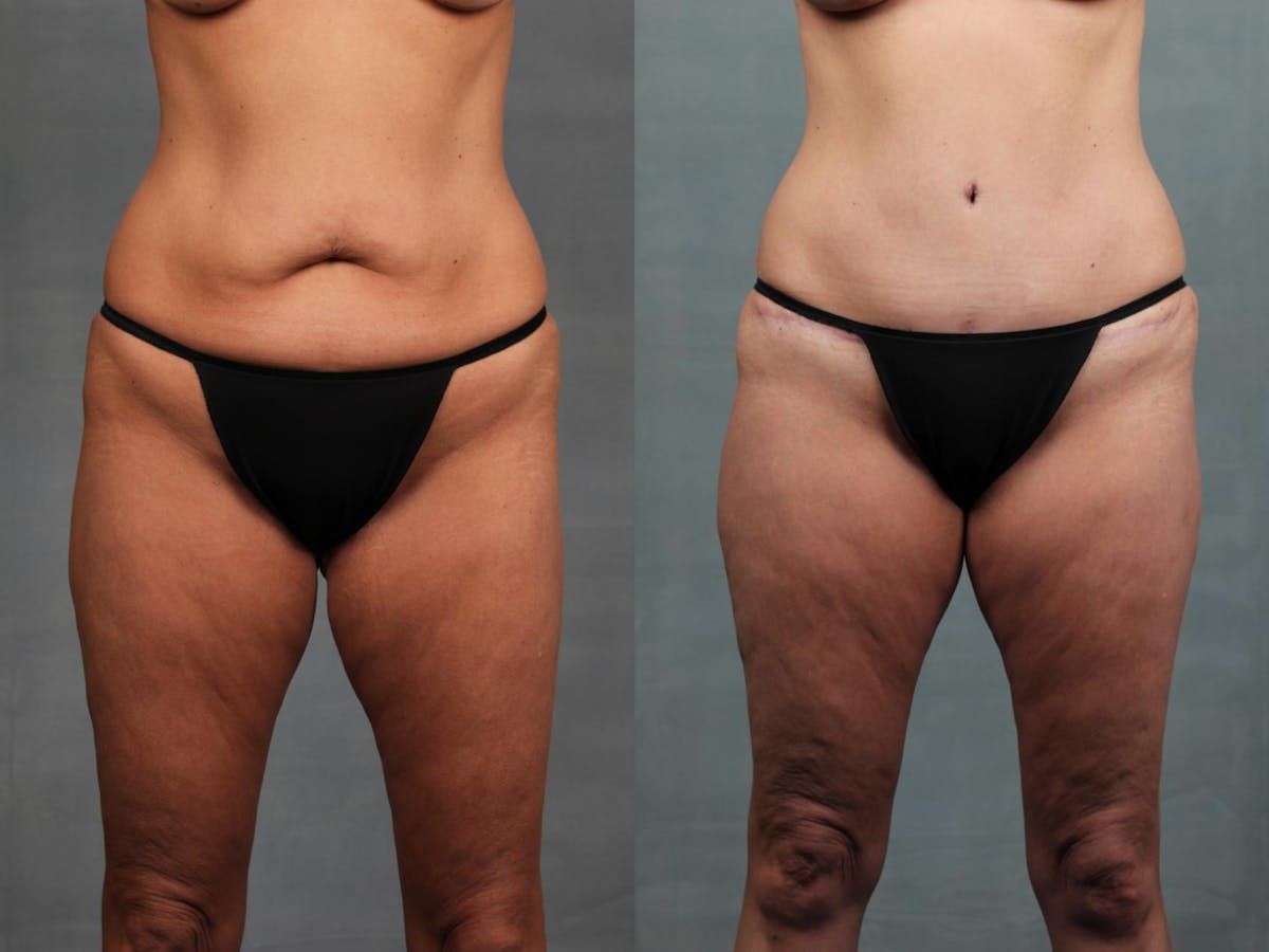 Mommy Makeover Before & After Gallery - Patient 281733 - Image 4