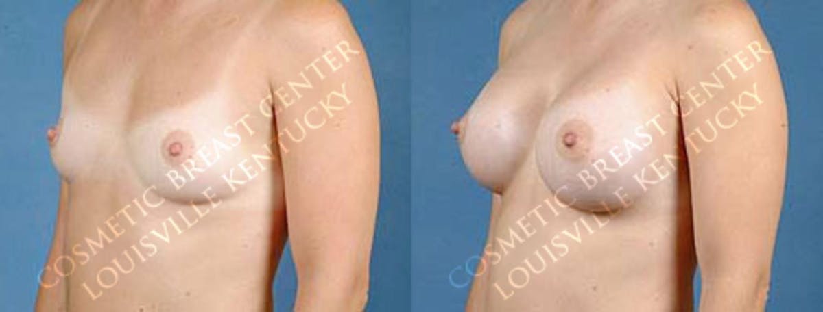 Enlargement - Saline Before & After Gallery - Patient 108710 - Image 2