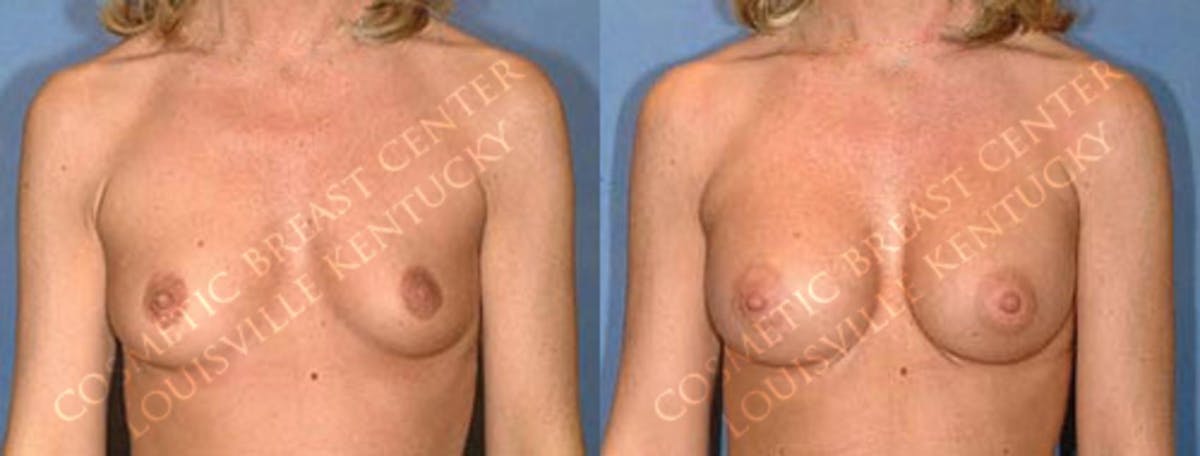 Enlargement - Saline Before & After Gallery - Patient 216257 - Image 1