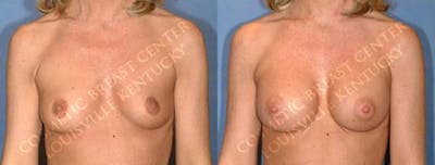Enlargement - Saline Before & After Gallery - Patient 216257 - Image 1