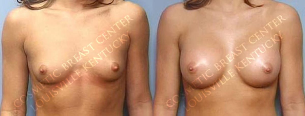 Enlargement - Saline Before & After Gallery - Patient 274728 - Image 1