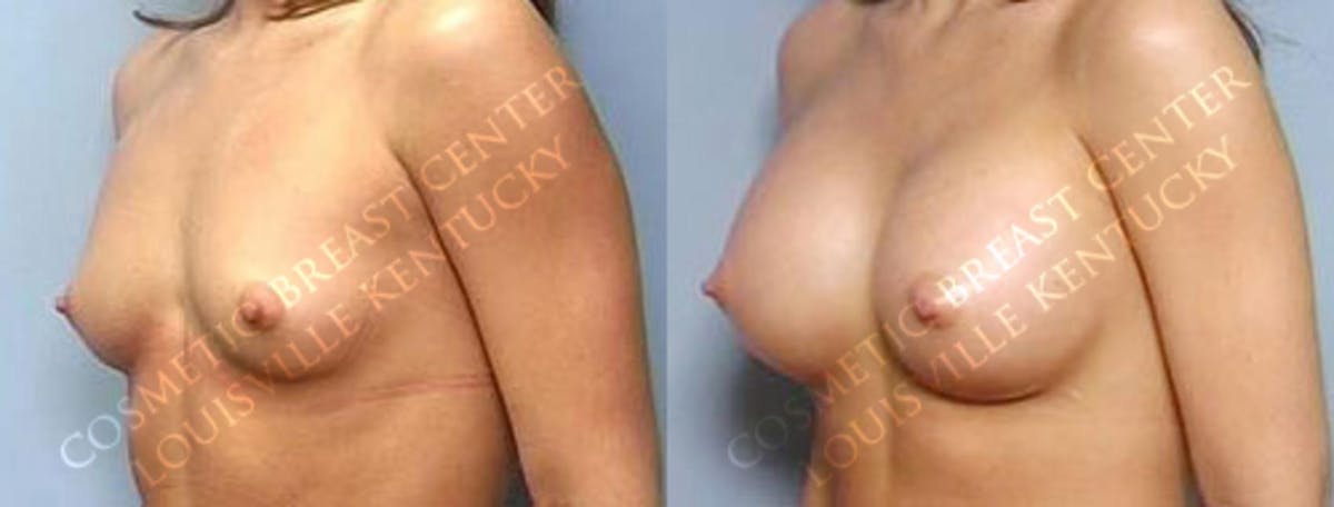 Enlargement - Saline Before & After Gallery - Patient 274728 - Image 2
