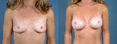 Enlargement - Saline Before & After Gallery - Patient 511456 - Image 1