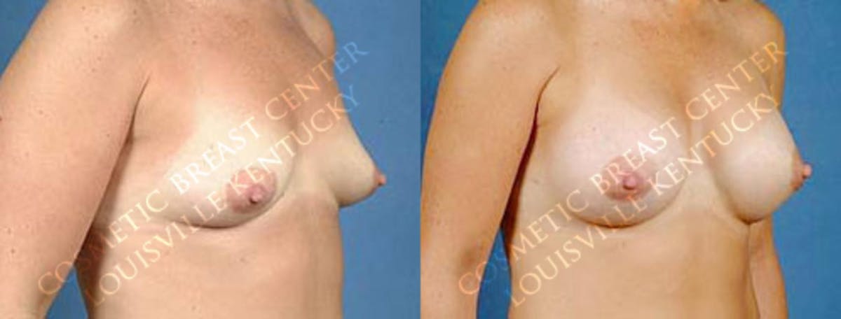 Enlargement - Saline Before & After Gallery - Patient 191689 - Image 2