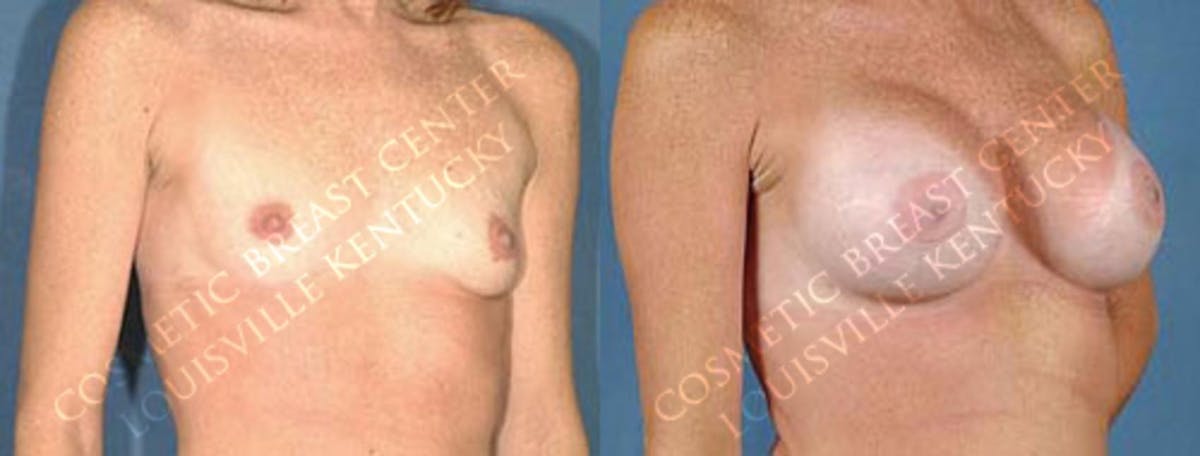 Enlargement - Saline Before & After Gallery - Patient 144137 - Image 2