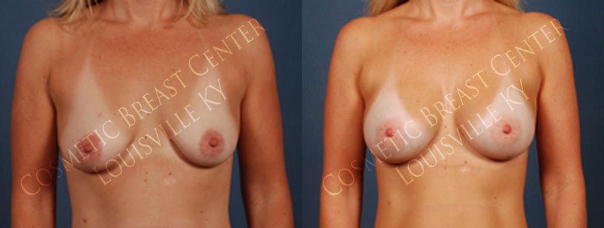 Enlargement - Saline Before & After Gallery - Patient 348316 - Image 1