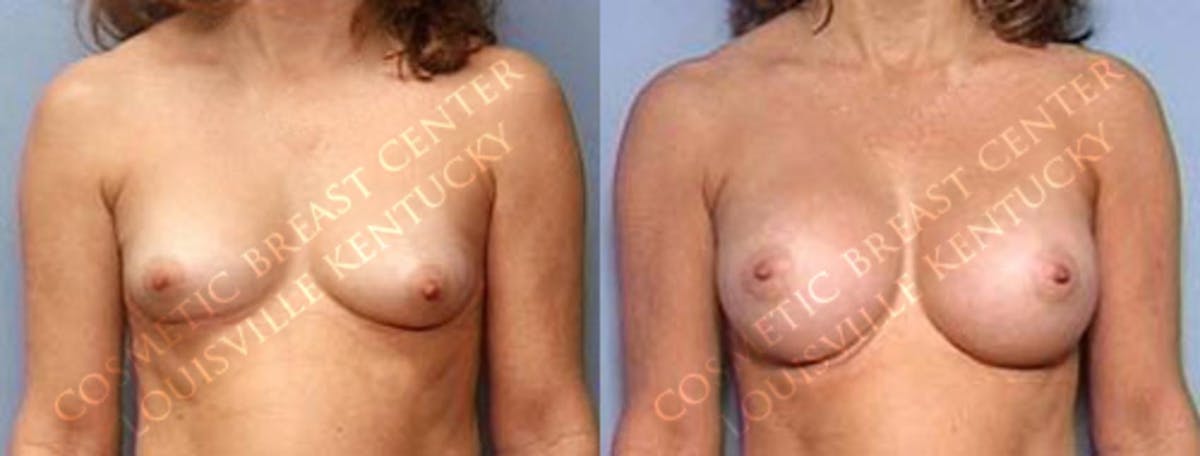 Enlargement - Saline Before & After Gallery - Patient 344037 - Image 1