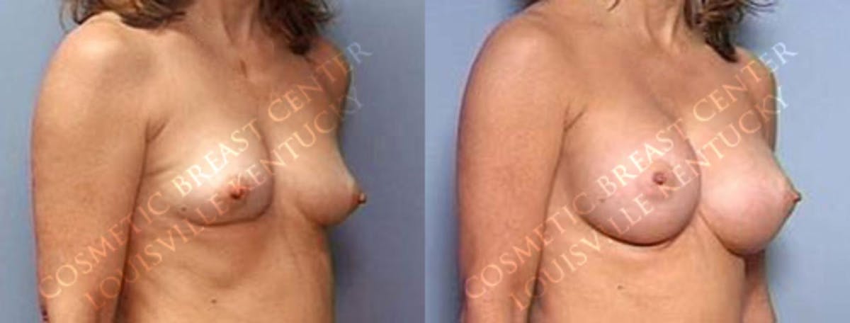 Enlargement - Saline Before & After Gallery - Patient 344037 - Image 2