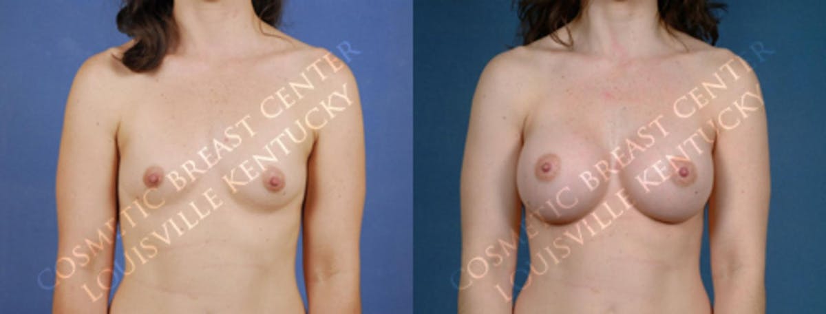 Enlargement - Saline Before & After Gallery - Patient 345587 - Image 1
