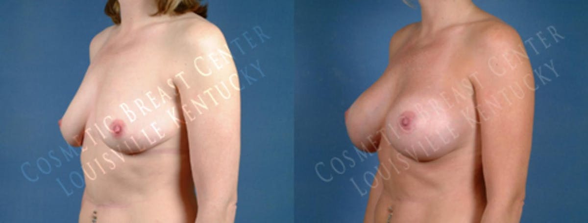 Enlargement - Saline Before & After Gallery - Patient 388032 - Image 2