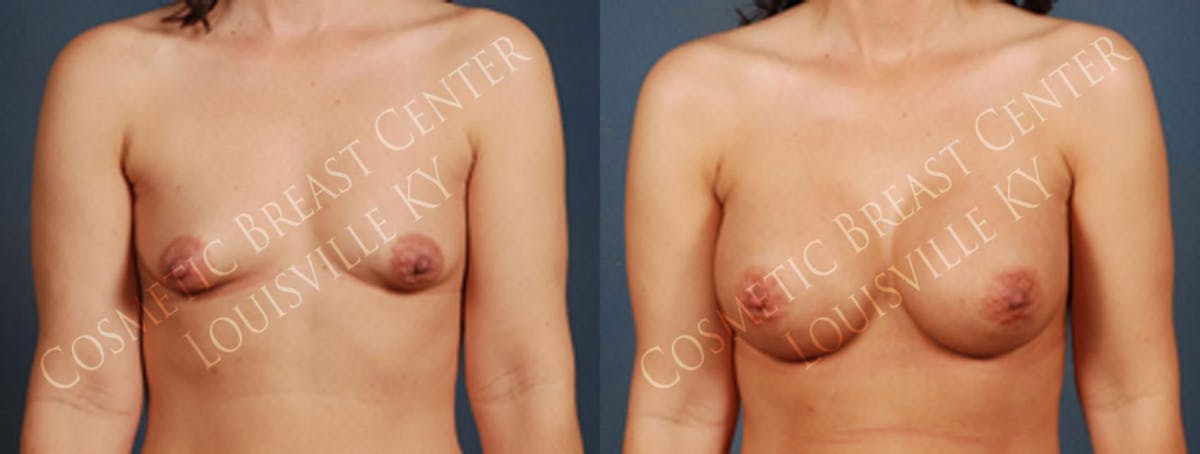 Enlargement - Saline Before & After Gallery - Patient 231942 - Image 1