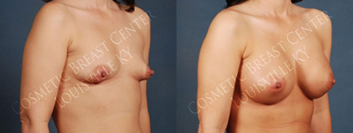 Enlargement - Saline Before & After Gallery - Patient 231942 - Image 2
