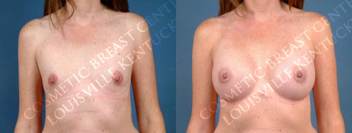 Enlargement - Silicone Before & After Gallery - Patient 199663 - Image 1