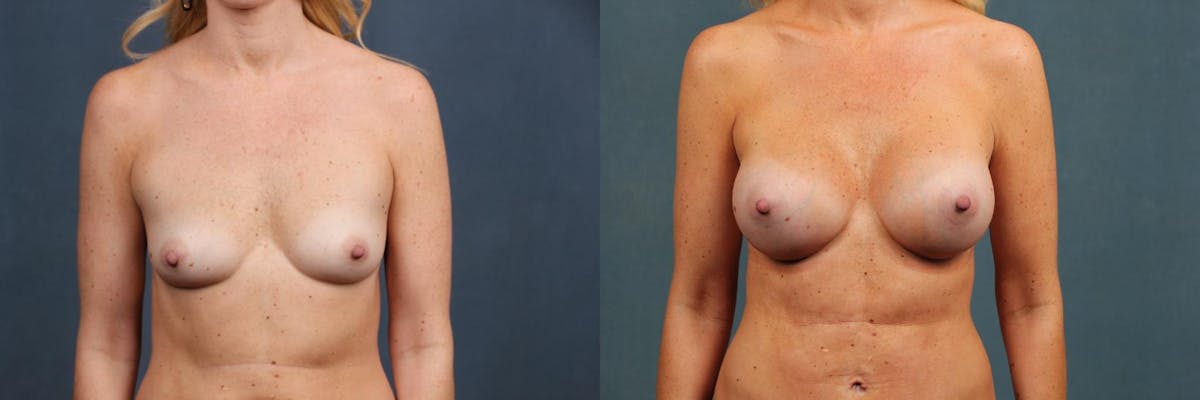 Enlargement - Silicone Before & After Gallery - Patient 140512 - Image 1