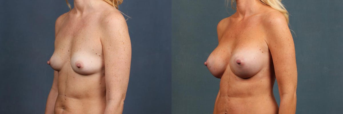 Enlargement - Silicone Before & After Gallery - Patient 140512 - Image 2