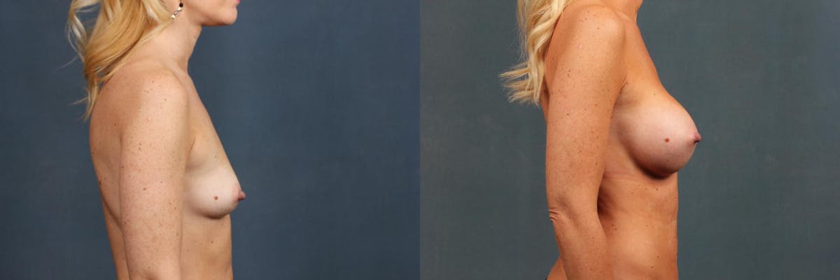 Enlargement - Silicone Before & After Gallery - Patient 140512 - Image 3