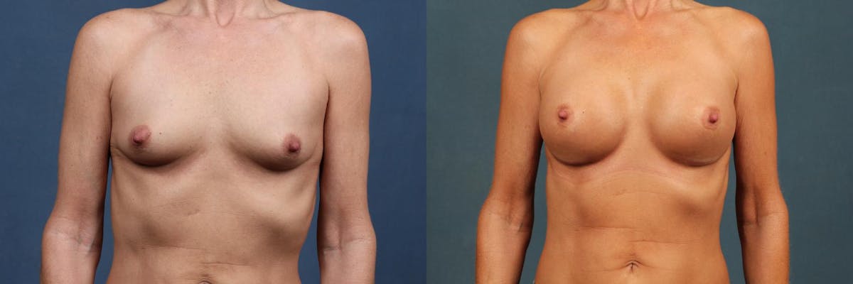 Enlargement - Silicone Before & After Gallery - Patient 354537 - Image 1