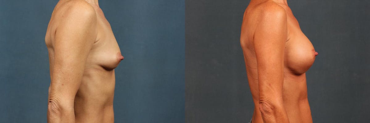 Enlargement - Silicone Before & After Gallery - Patient 354537 - Image 3