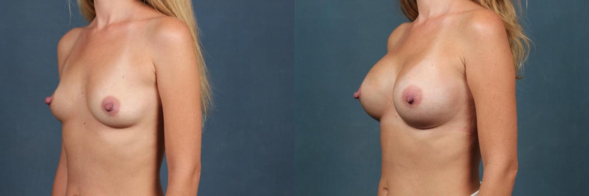 Enlargement - Silicone Before & After Gallery - Patient 229624 - Image 3