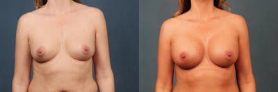 Enlargement - Silicone Before & After Gallery - Patient 852498 - Image 1