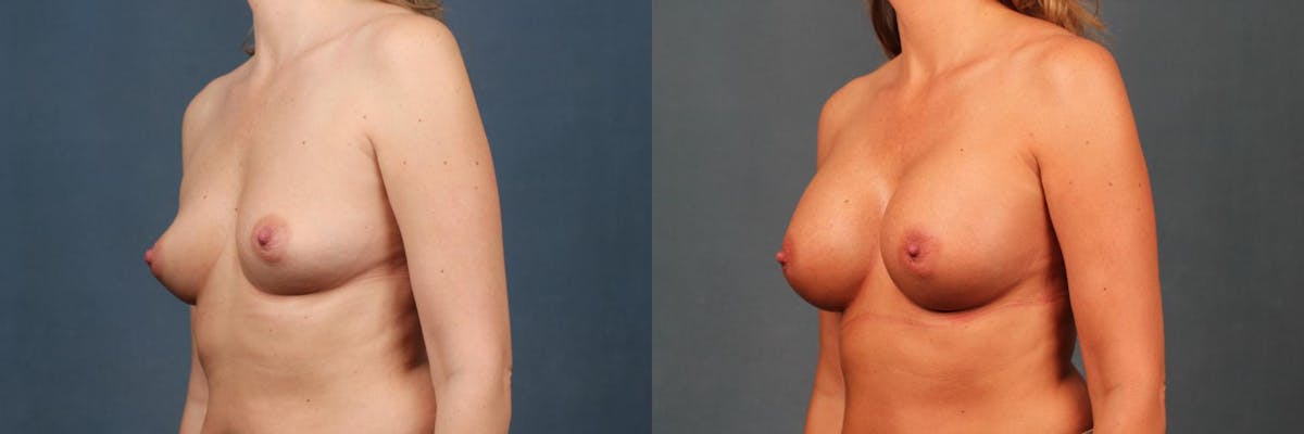 Enlargement - Silicone Before & After Gallery - Patient 852498 - Image 2