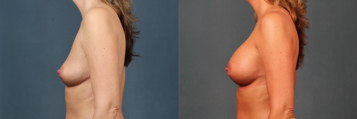 Enlargement - Silicone Before & After Gallery - Patient 852498 - Image 3