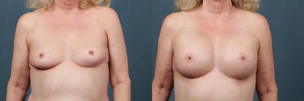 Enlargement - Silicone Before & After Gallery - Patient 263784 - Image 1