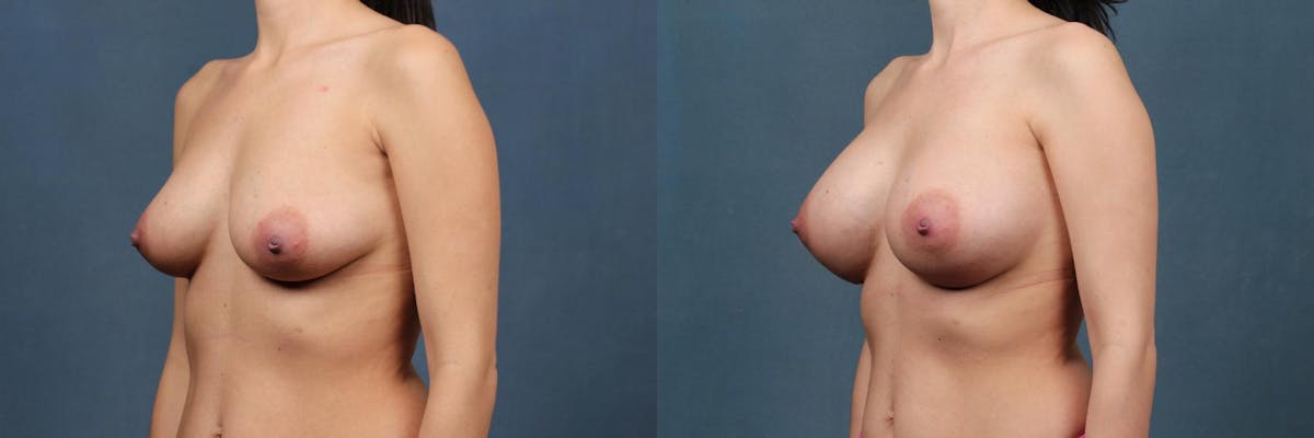 Enlargement - Silicone Before & After Gallery - Patient 424653 - Image 2