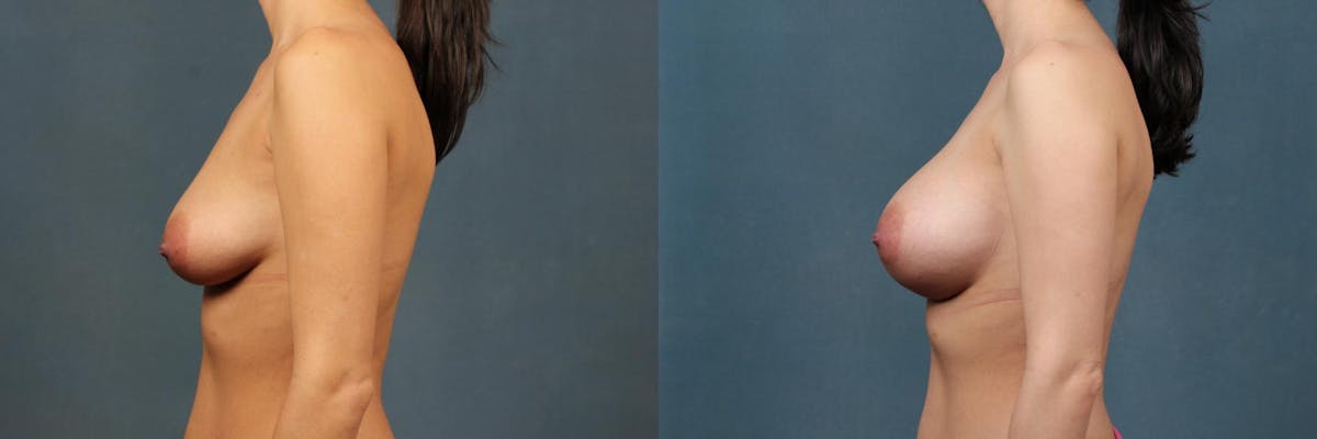 Enlargement - Silicone Before & After Gallery - Patient 424653 - Image 3