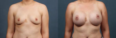 Enlargement - Silicone Before & After Gallery - Patient 360121 - Image 1