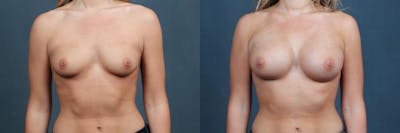 Enlargement - Silicone Before & After Gallery - Patient 419917 - Image 1