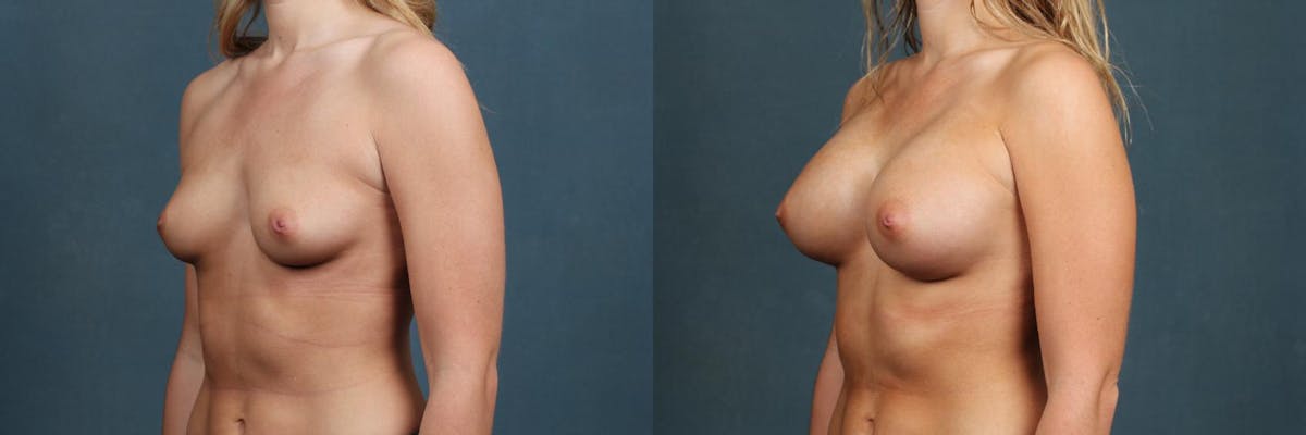 Enlargement - Silicone Before & After Gallery - Patient 419917 - Image 2