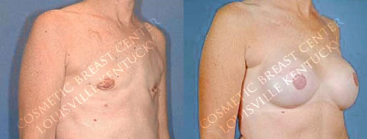 Reconstruction Before & After Gallery - Patient 126017 - Image 2
