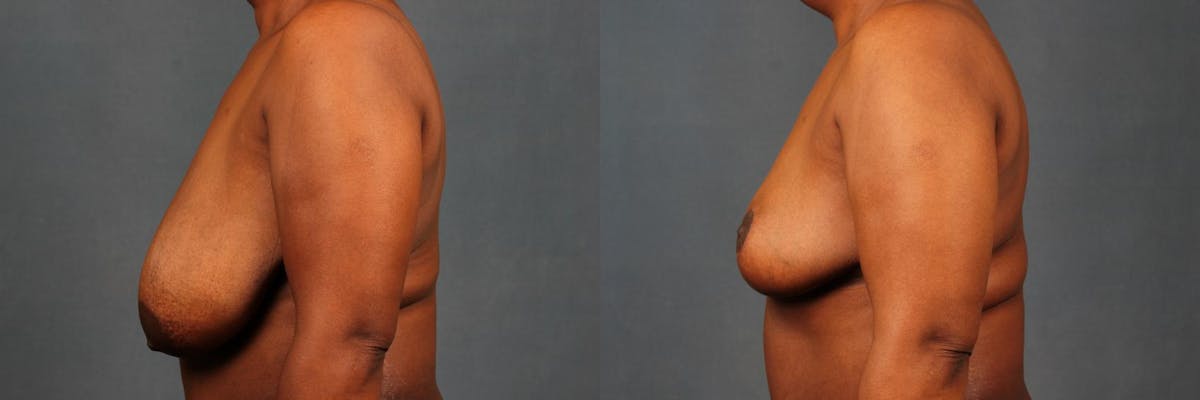 Reduction Before & After Gallery - Patient 407834 - Image 3