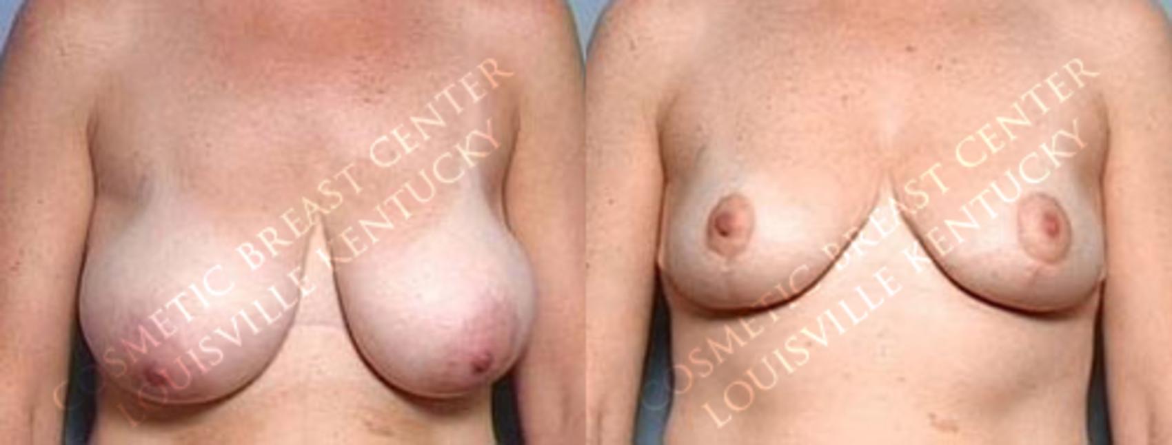 breast reduction patient