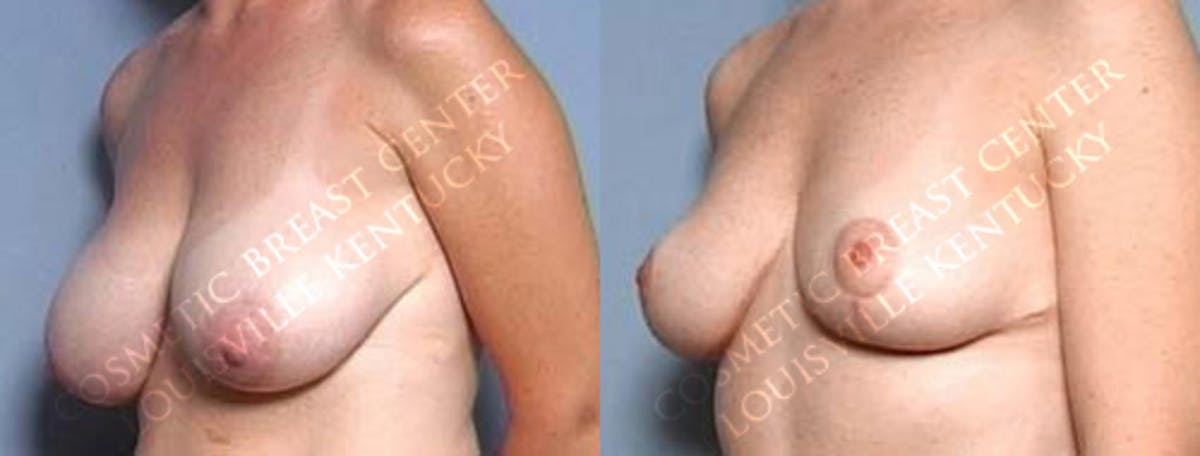 Reduction Before & After Gallery - Patient 691464 - Image 2