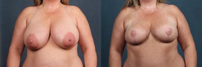 Reduction Before & After Gallery - Patient 179345 - Image 1