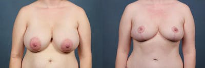 Reduction Before & After Gallery - Patient 972517 - Image 1