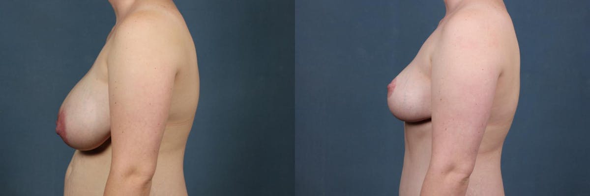 Reduction Before & After Gallery - Patient 972517 - Image 2